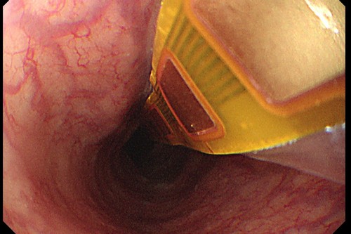 內視鏡食道黏膜電阻抗測量儀上的氣球與微晶片進到人體食道內